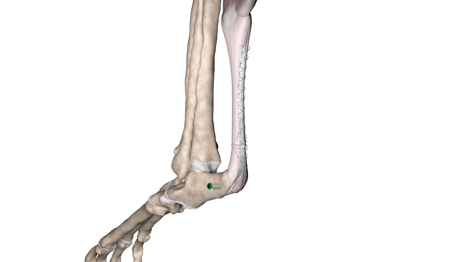Achilles Tendon - with suturing