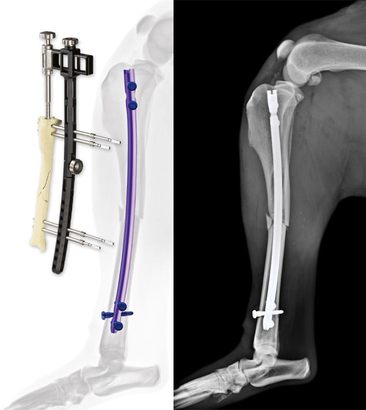 Surg’X Interlocking Nail System and Xray of tibia