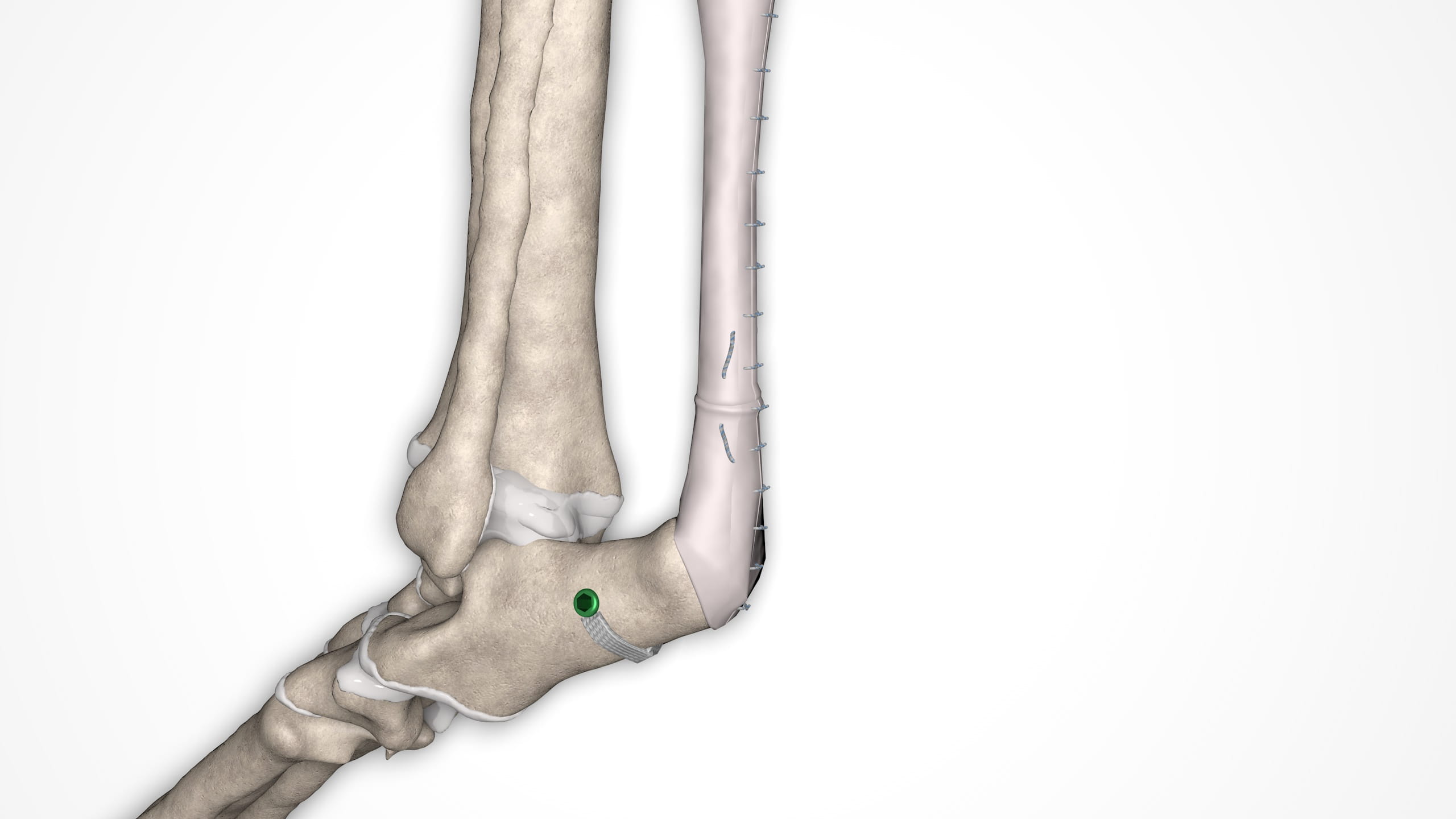 Achilles tendon repair on canine bone model rendering image